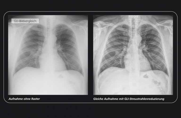 GLI (Gridless Imaging) - Reduzierung der Streustrahlung: professionelle  dicomPACS DX-R Bildprozessing