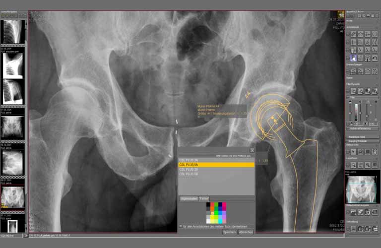  Prothesendokumentation mit digitalen Schablonen