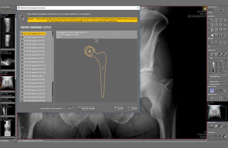 Prosthetic template is selected from a set of templates and displayed as annotation in the image