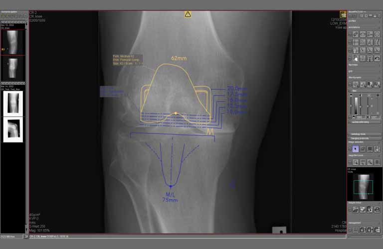 Planificación de la cirugía preoperatoria con el módulo de documentación de prótesis