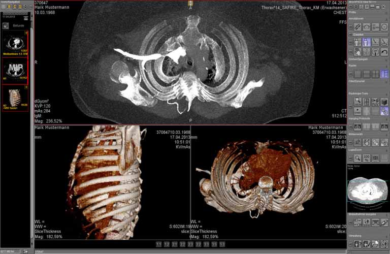 PACS-Software Befundung von Schnittbildern für CT und MRT (Hanging Protokolle, Cine Loop, MPR, MIP etc.)