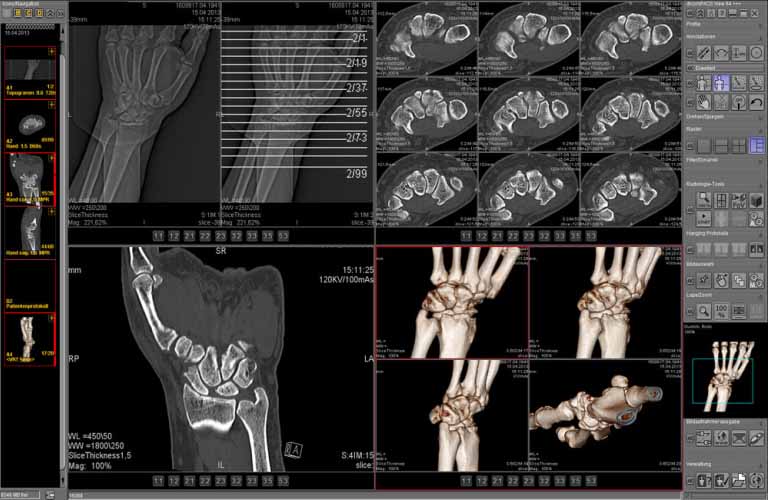 Funktionen MPR (Multi Planare Rekonstruktion) und MIP (Maximum Intensity Projection)