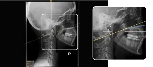 NUCCA: S-Line and Hard Palate Line