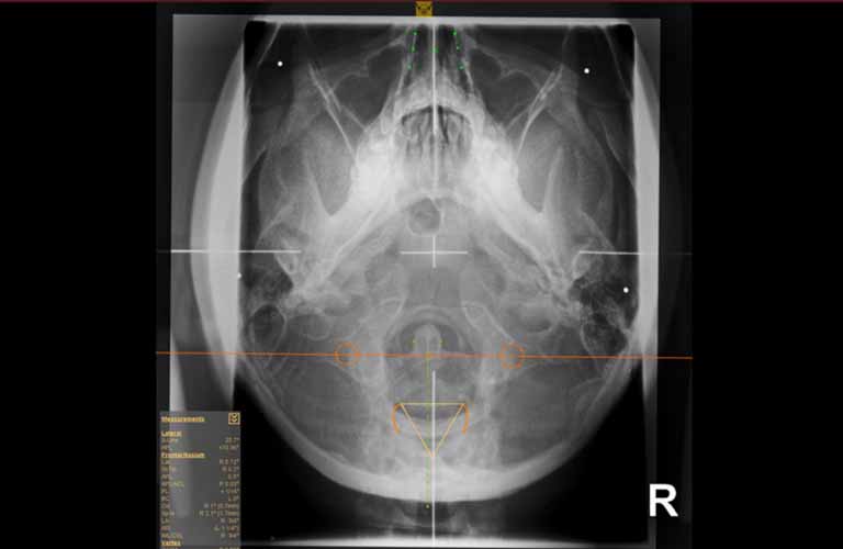 Upper Cervical (NUCCA) y Standard Chiropractic Tools: Squamous Sutures