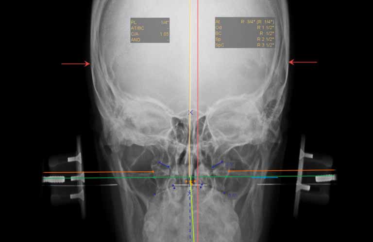 NUCCA: Atlas Plane Line and Atlas Check Line