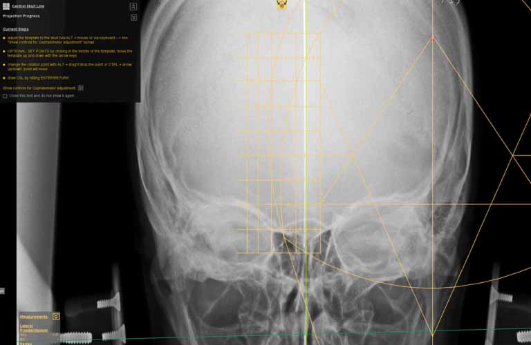 Diagnostic tools for Upper Cervical Chiropractic (NUCCA)